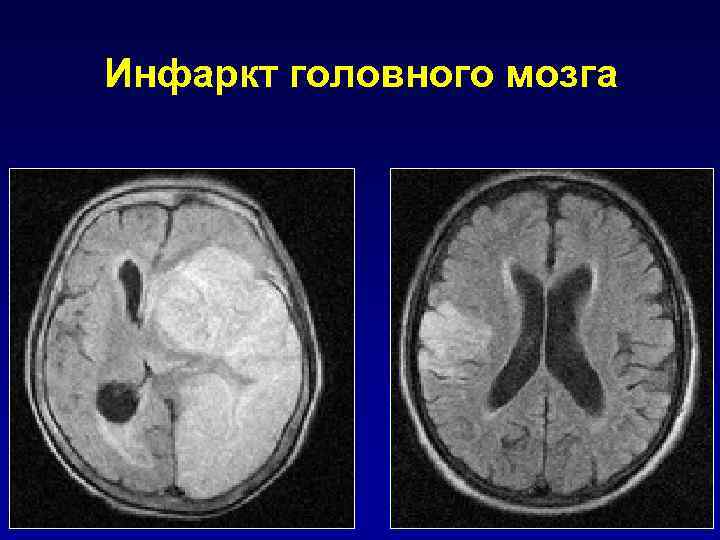 Мр картина единичных мелкоочаговых изменений белого вещества головного мозга сосудистого характера