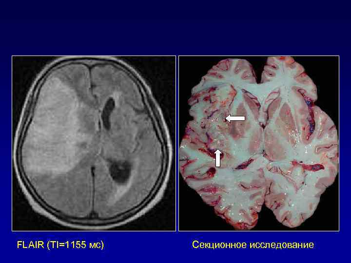 FLAIR (TI=1155 мс) Секционное исследование 