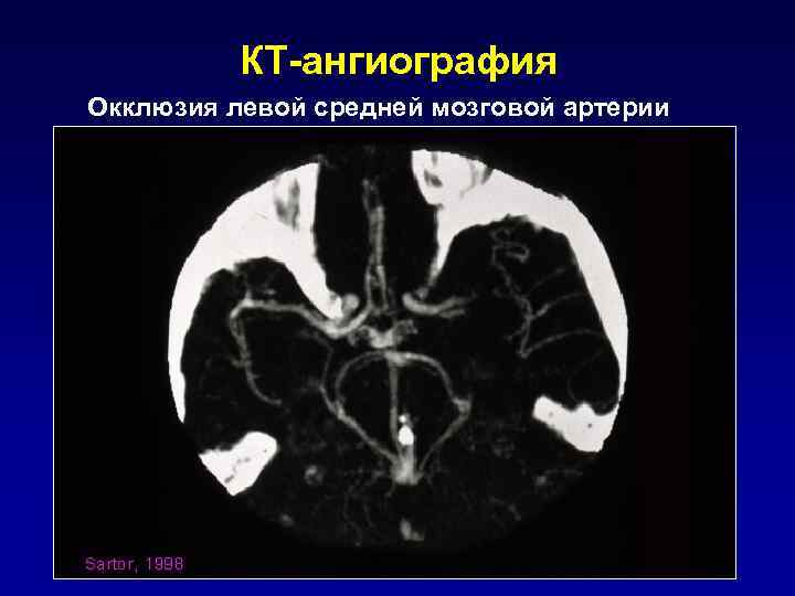 Левая средняя мозговая артерия инсульт. Ишемический инсульт кт ангиография.