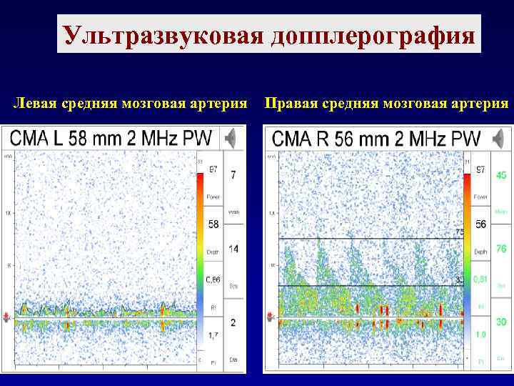 Ультразвуковая допплерография Левая средняя мозговая артерия Правая средняя мозговая артерия 