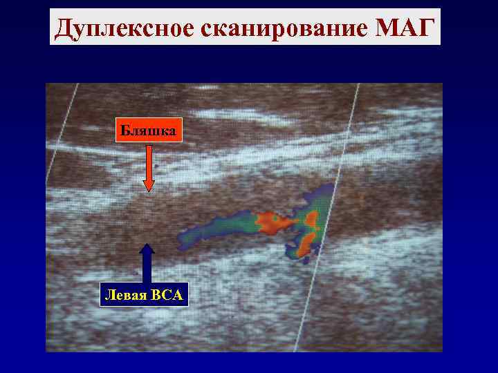 Дуплексное сканирование что это. Дуплексное сканирование магистральных артерий головы. Дуплексное сканирование маг. Дуплексное сканирование магистральных артерий головы ковров. Дуплексное сканирование ДСМАГ.