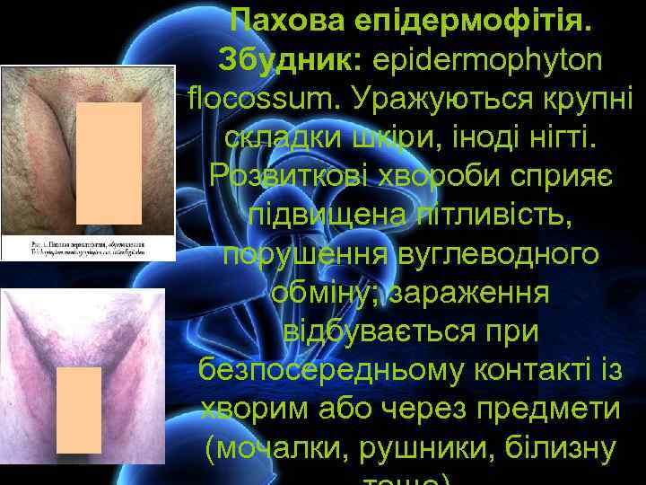 Пахова епідермофітія. Збудник: epidermophyton flocossum. Уражуються крупні складки шкіри, іноді нігті. Розвиткові хвороби сприяє