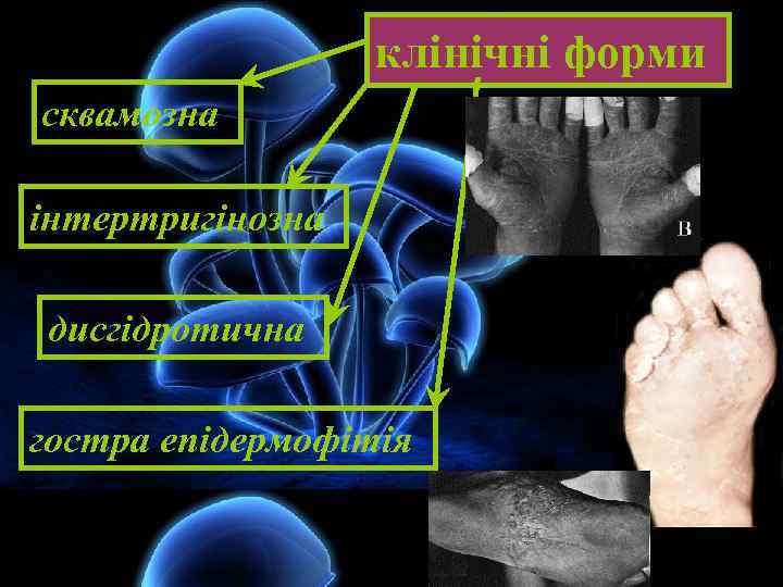 клінічні форми сквамозна інтертригінозна дисгідротична гостра епідермофітія 