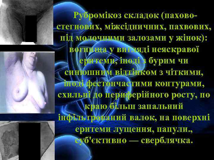 Рубромікоз складок (паховостегнових, міжсідничних, пахвових, під молочними залозами у жінок): вогнища у вигляді неяскравої