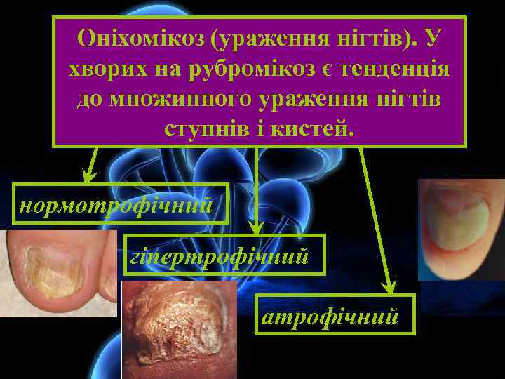 Оніхомікоз (ураження нігтів). У хворих на рубромікоз є тенденція до множинного ураження нігтів ступнів