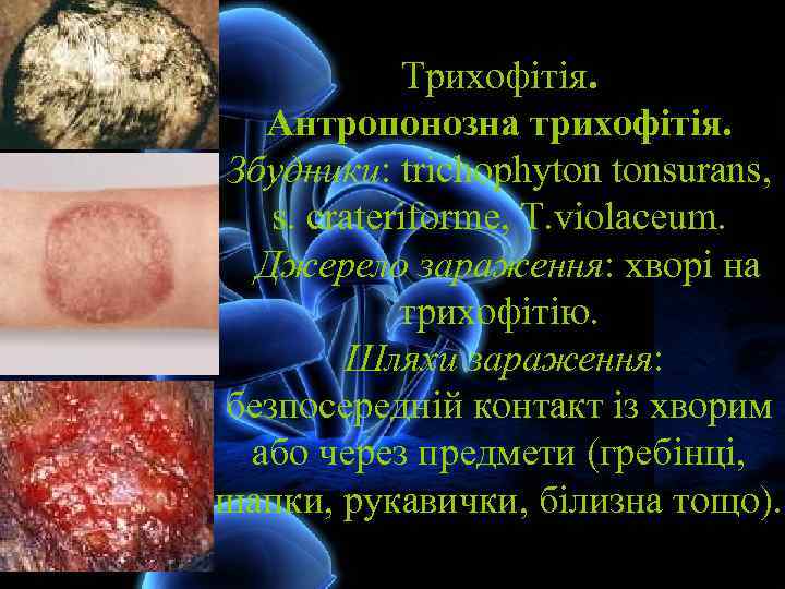 Трихофітія. Антропонозна трихофітія. Збудники: trichophyton tonsurans, s. crateriforme, T. violaceum. Джерело зараження: хворі на