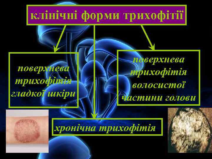 клінічні форми трихофітії поверхнева трихофітія гладкої шкіри поверхнева трихофітія волосистої частини голови хронічна трихофітія