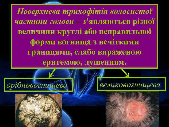 Поверхнева трихофітія волосистої частини голови – з’являються різної величини круглі або неправильної форми вогнища