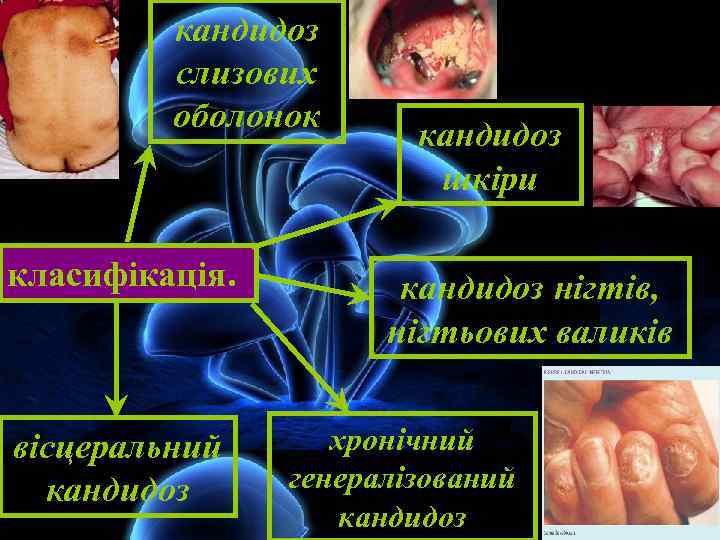 кандидоз слизових оболонок класифікація. вісцеральний кандидоз шкіри кандидоз нігтів, нігтьових валиків хронічний генералізований кандидоз