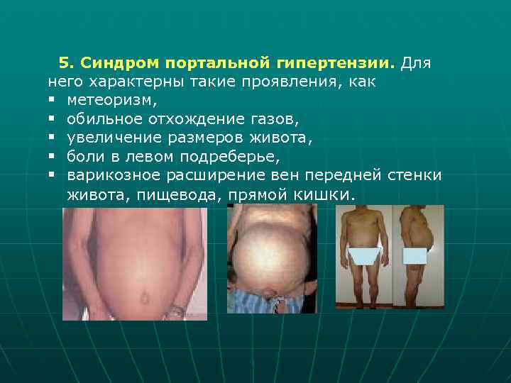 5. Синдром портальной гипертензии. Для него характерны такие проявления, как § метеоризм, § обильное