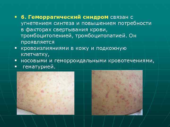 § 6. Геморрагический синдром связан с угнетением синтеза и повышением потребности в факторах свертывания