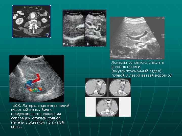 Локация основного ствола в воротах печени (внутрипеченочный отдел), правой и левой ветвей воротной вены
