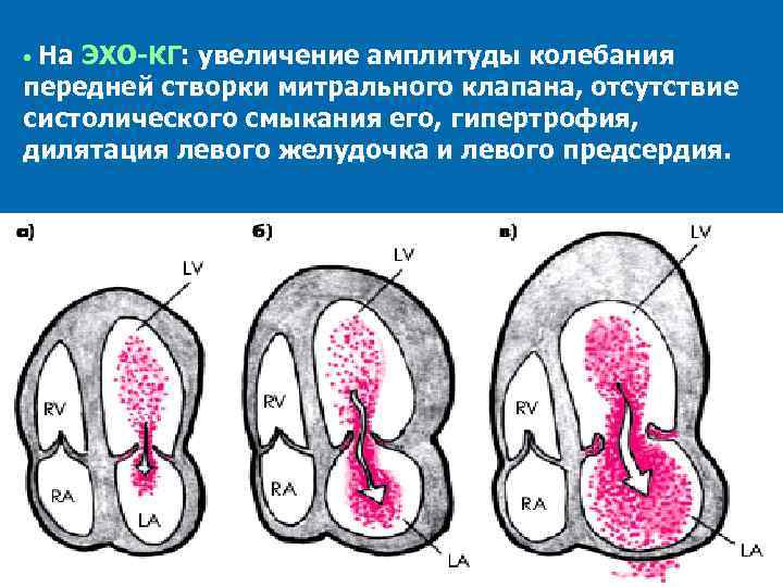 Изменение створок митрального клапана