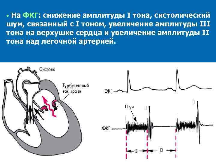 Систолический шум у левого края