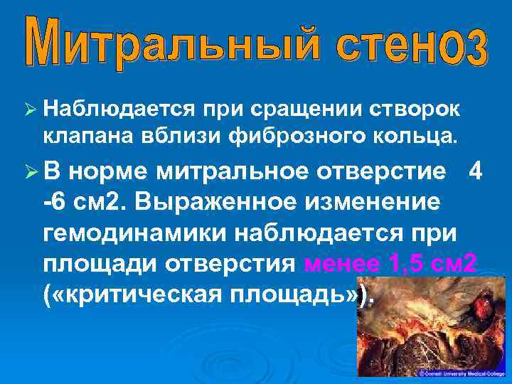 Ø Наблюдается при сращении створок клапана вблизи фиброзного кольца. Ø В норме митральное отверстие