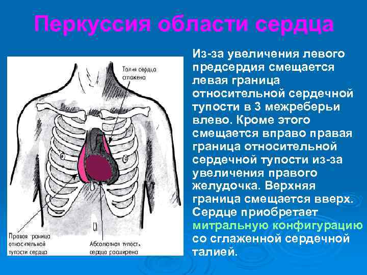 Перкуссия абсолютной тупости сердца