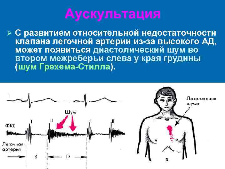 Недостаточность клапана легочной артерии