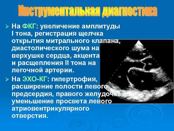 На ФКГ: увеличение амплитуды I тона, регистрация щелчка открытия митрального клапана, диастолического шума на