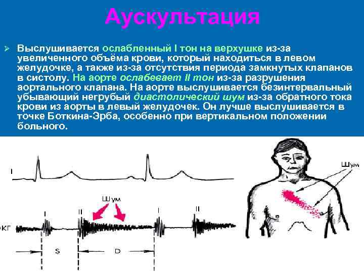 Аускультативная картина при аортальном стенозе характеризуется появлением