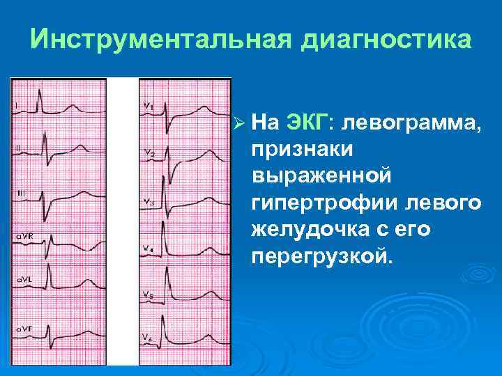Инструментальная диагностика Ø На ЭКГ: левограмма, признаки выраженной гипертрофии левого желудочка с его перегрузкой.