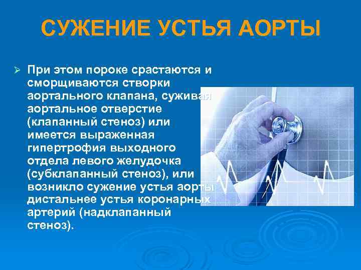СУЖЕНИЕ УСТЬЯ АОРТЫ Ø При этом пороке срастаются и сморщиваются створки аортального клапана, суживая