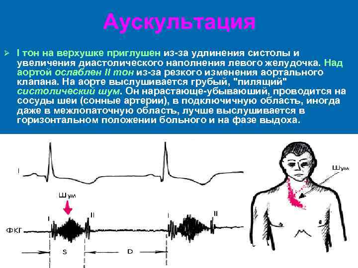 Аускультация Ø I тон на верхушке приглушен из-за удлинения систолы и увеличения диастолического наполнения