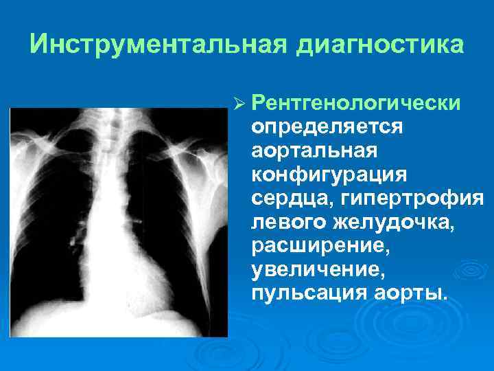 Инструментальная диагностика Ø Рентгенологически определяется аортальная конфигурация сердца, гипертрофия левого желудочка, расширение, увеличение, пульсация