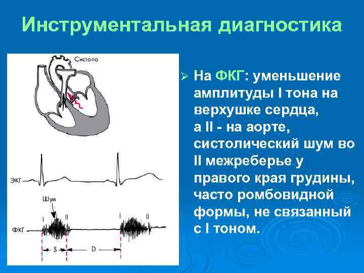 Диагноз шумы. Тоны сердца на ФКГ. Систолический шум у основания грудины. Систолический шум на ФКГ. Ромбовидный систолический шум.