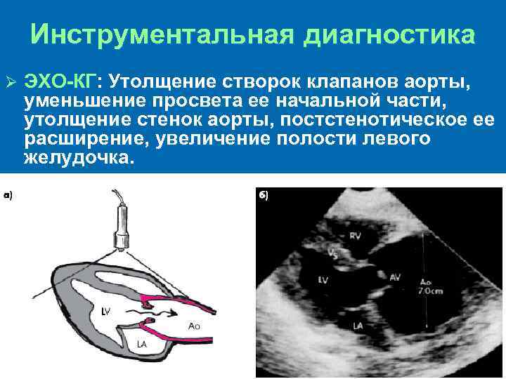 Клапан аорты створки уплотнены