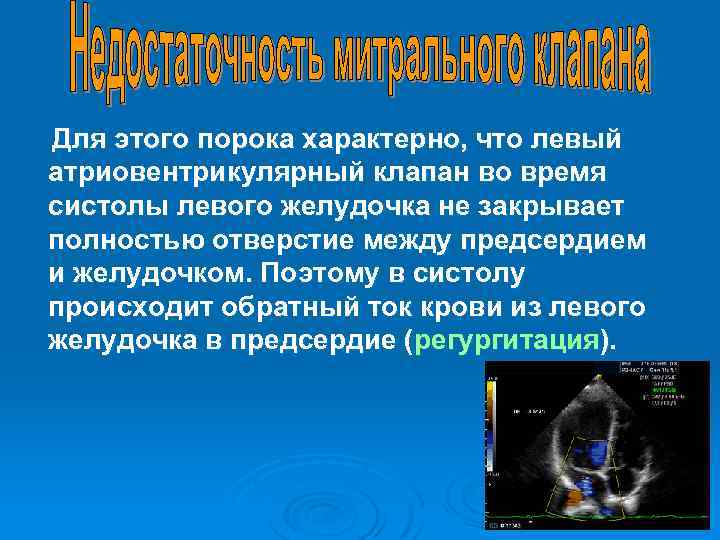 Для этого порока характерно, что левый атриовентрикулярный клапан во время систолы левого желудочка не