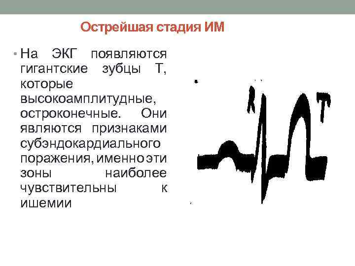 Отрицательный зубец т на экг. ЭКГ высокий зубец т v2-v4. Изоэлектрический зубец т на ЭКГ. Амплитуда зубца т на ЭКГ В норме. Остроконечный зубец т на ЭКГ.