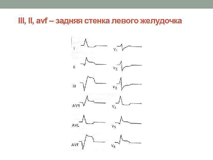 ІІІ, avf – задняя стенка левого желудочка 