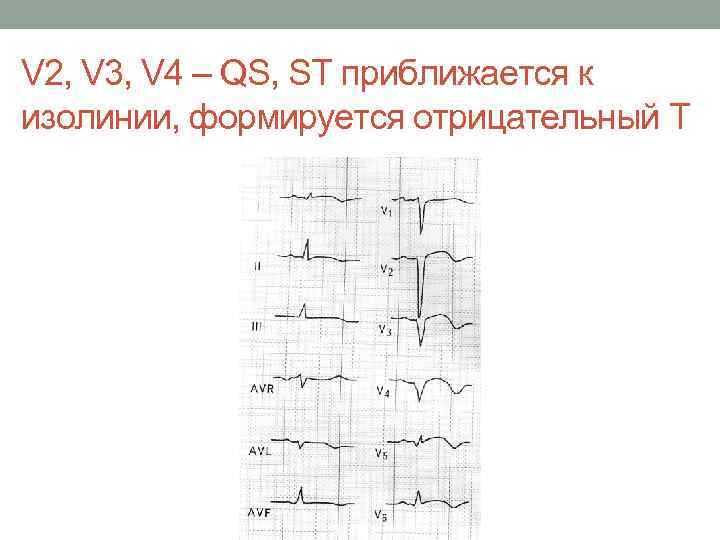 V 2, V 3, V 4 – QS, SТ приближается к изолинии, формируется отрицательный