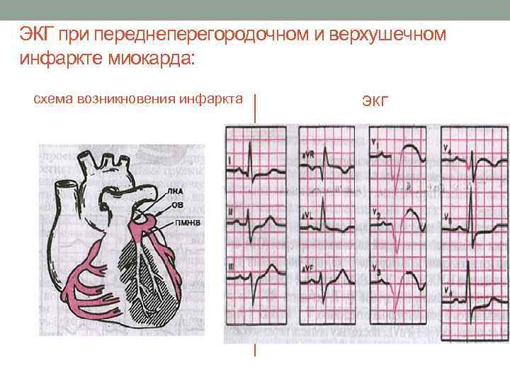 ЭКГ при переднеперегородочном и верхушечном инфаркте миокарда: схема возникновения инфаркта ЭКГ 