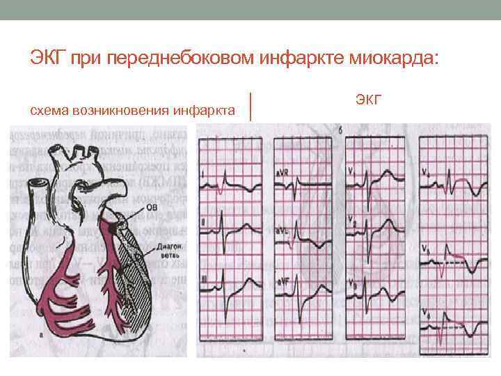 ЭКГ при переднебоковом инфаркте миокарда: схема возникновения инфаркта ЭКГ 