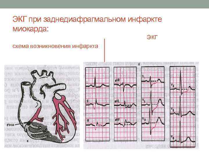 ЭКГ при заднедиафрагмальном инфаркте миокарда: ЭКГ схема возникновения инфаркта 