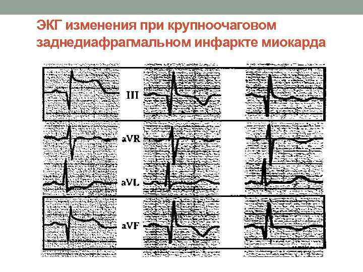 ЭКГ изменения при крупноочаговом заднедиафрагмальном инфаркте миокарда 