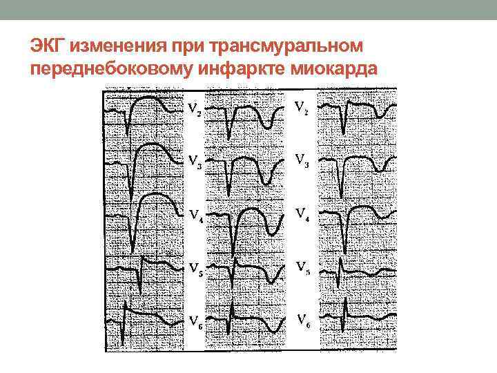 Трансмуральный инфаркт. ЭКГ при трансмуральном инфаркте. Трансмуральный инфаркт ЭКГ признаки. Изменения ЭКГ при трансмуральном инфаркте миокарда. Трансмуральный инфаркт миокарда изменения на ЭКГ.