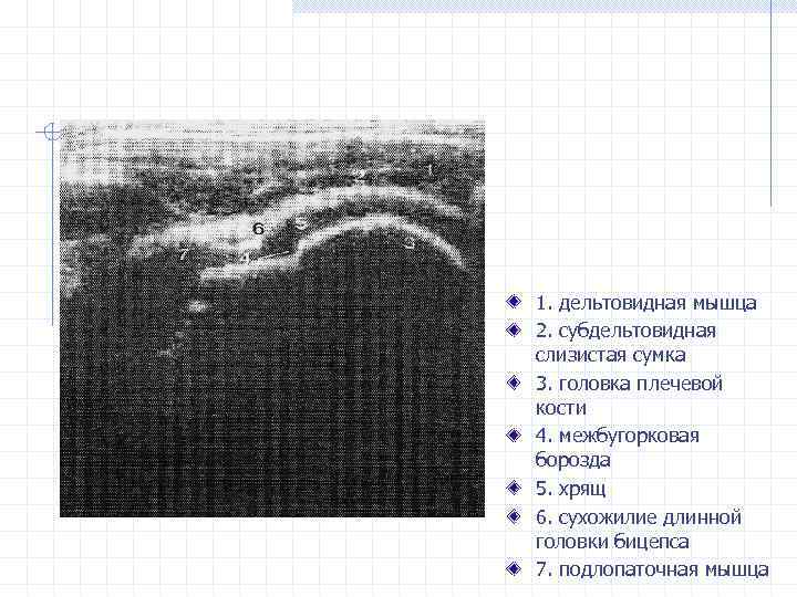 1. дельтовидная мышца 2. субдельтовидная слизистая сумка 3. головка плечевой кости 4. межбугорковая борозда