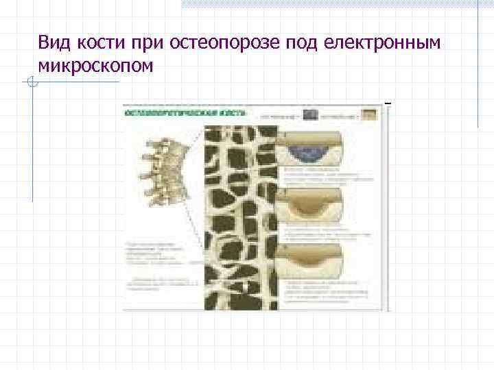 Вид кости при остеопорозе под електронным микроскопом 