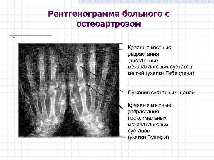 На рисунках представлены рентгенограммы суставов человека какой цифрой отмечена рентгенограмма