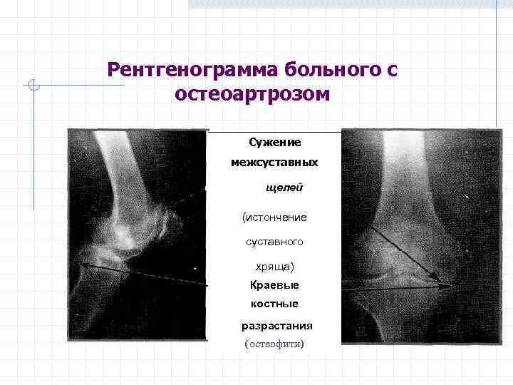 Рентгенограмма больного с остеоартрозом Сужение межсуставных щелей (истончение суставного хряща) Краевые костные разрастания (остеофити)