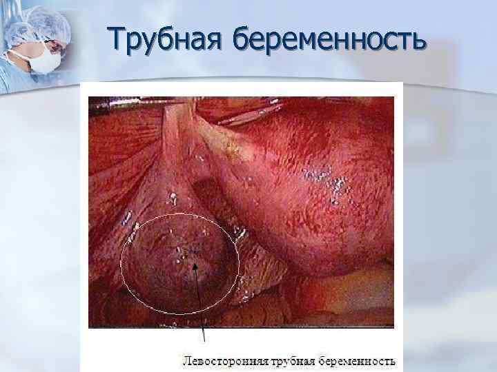 Трубная беременность 