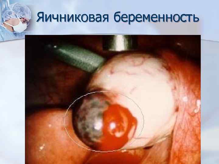Яичниковая беременность 