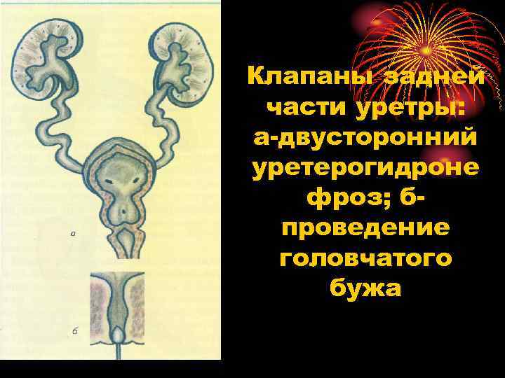 Клапаны задней части уретры: а двусторонний уретерогидроне фроз; б проведение головчатого бужа 
