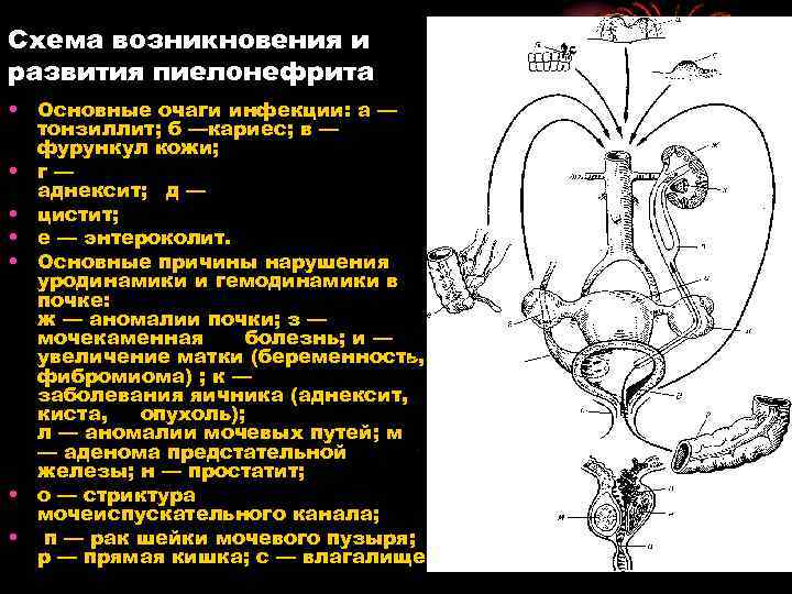 Схема возникновения и развития пиелонефрита • Основные очаги инфекции: а — тонзиллит; б —кариес;