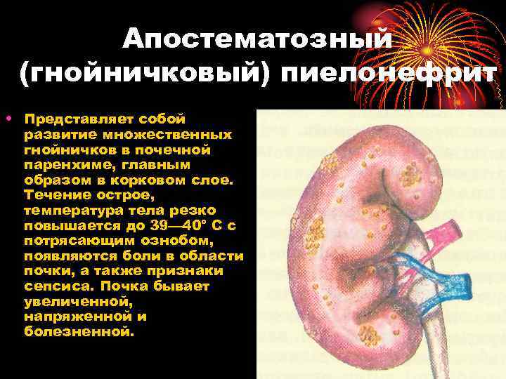 Апостематозный (гнойничковый) пиелонефрит • Представляет собой развитие множественных гнойничков в почечной паренхиме, главным образом