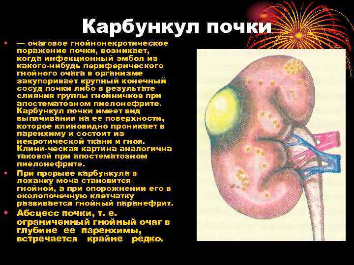  • • Карбункул почки — очаговое гнойнонекротическое поражение почки, возникает, когда инфекционный эмбол