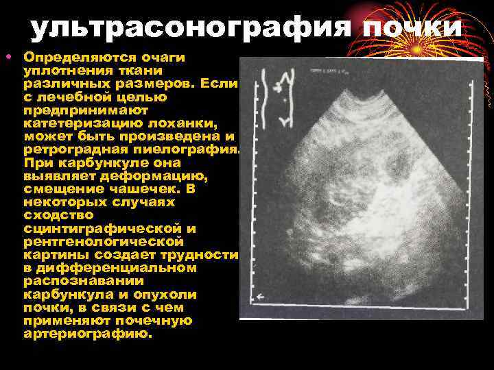 ультрасонография почки • Определяются очаги уплотнения ткани различных размеров. Если с лечебной целью предпринимают