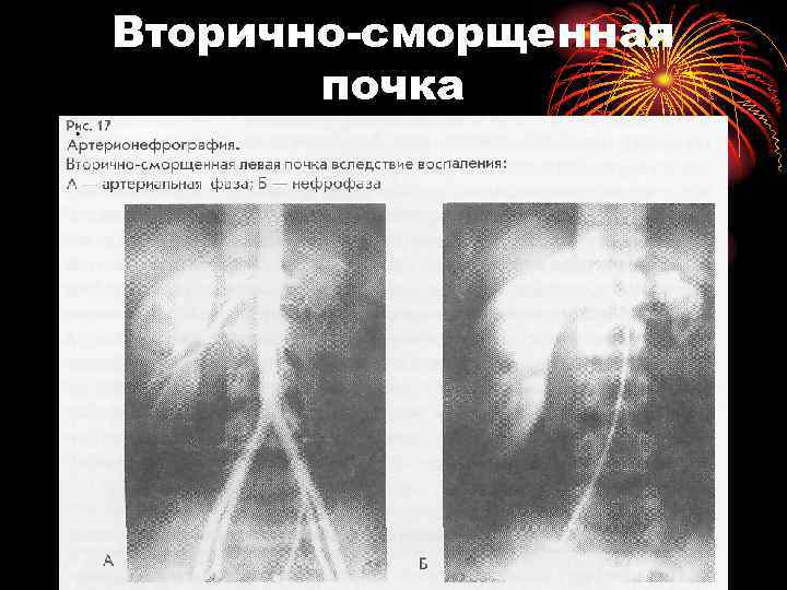 Вторично сморщенная почка 